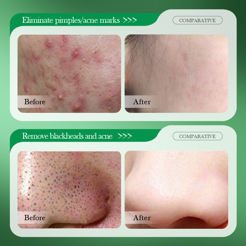 Crema per il Trattamento dell' - Salicylic Acid Blackhead Remover recensione e prezzo